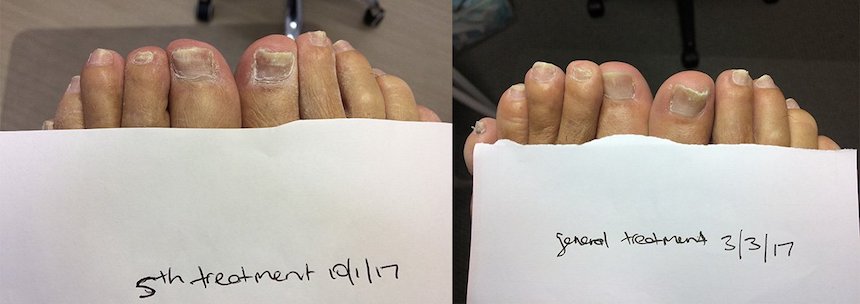 Laser for Fungal Nails