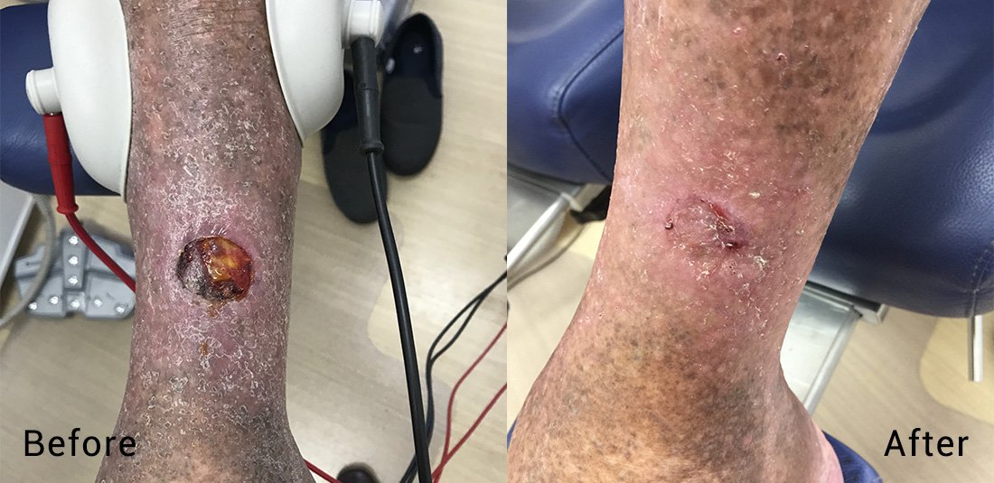 Healing a Difficult Leg Ulcer Using Bodyflow