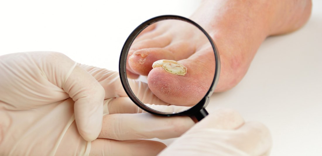 Treating A Stubborn Fungal Nail Infection Using Cold Laser