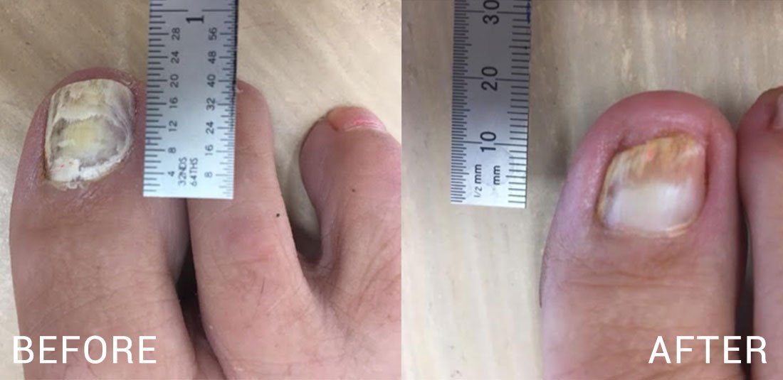 Lunula Laser