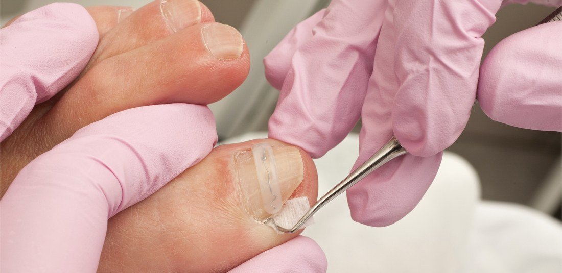 Permanently Correcting A Painful Ingrown Toenail