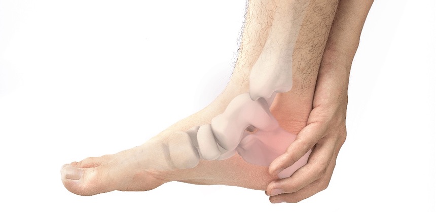 Treating plantar fasciitis with shockwave