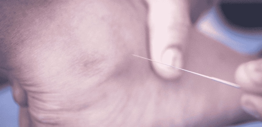 Dry Needling Explained
