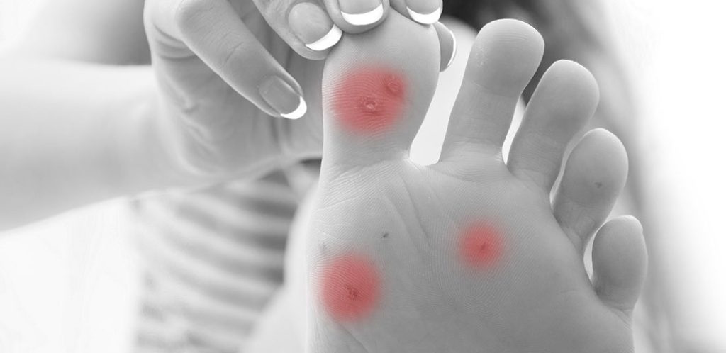 Plantar Warts Treatment