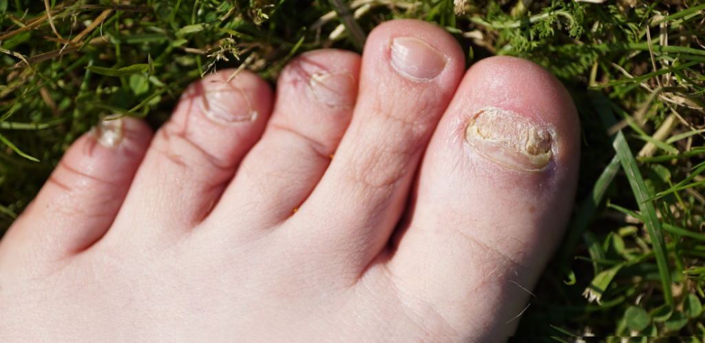 Fungal Toenail Infection Finally Gone Using Laser Treatment