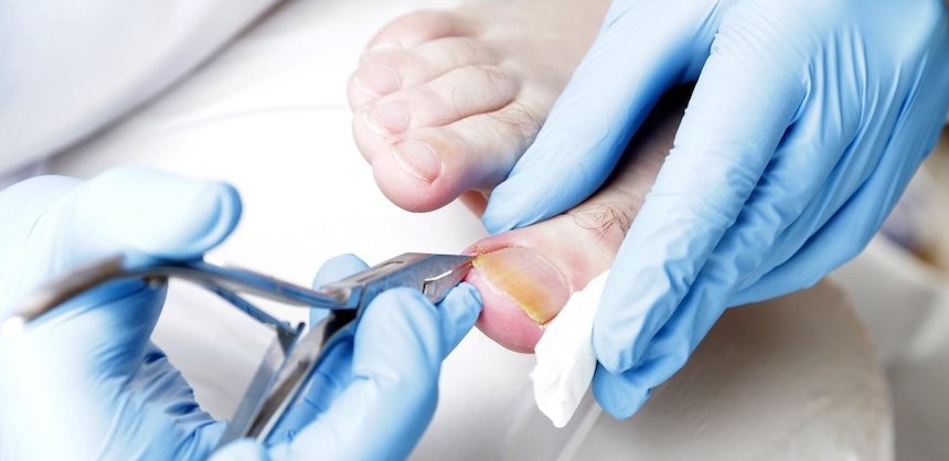 Permanent solution for ingrown toenails