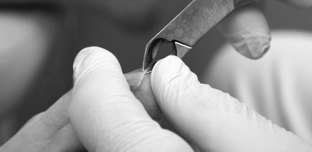 The Ins & Outs of Ingrown Toenails