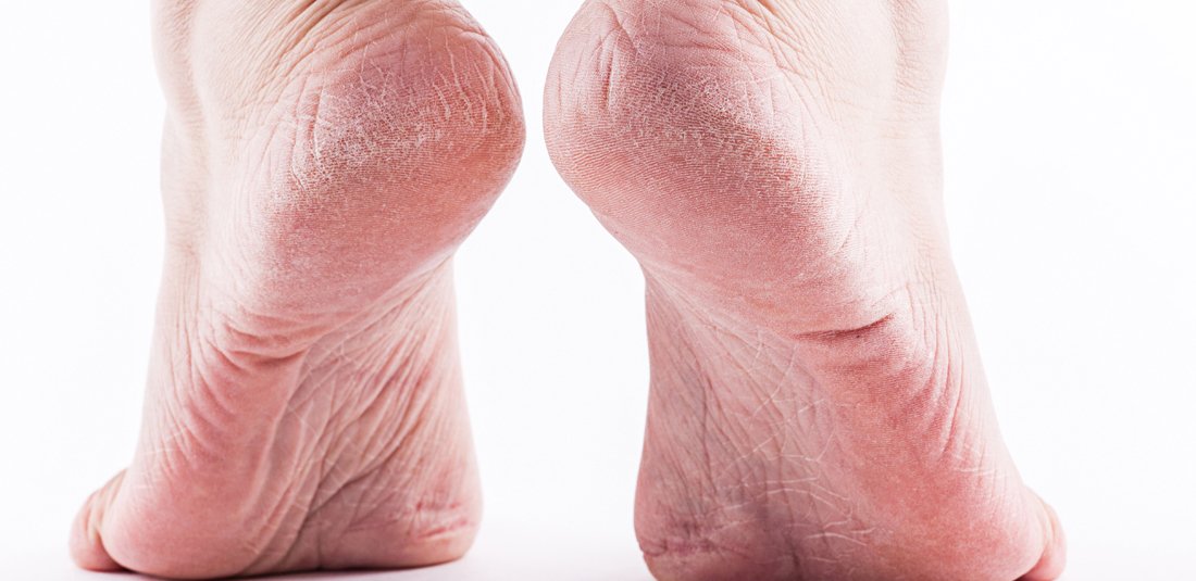 Why Do I Have Corns, Calluses