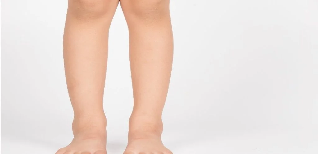 Managing Painful Knock Knees In A Young Child