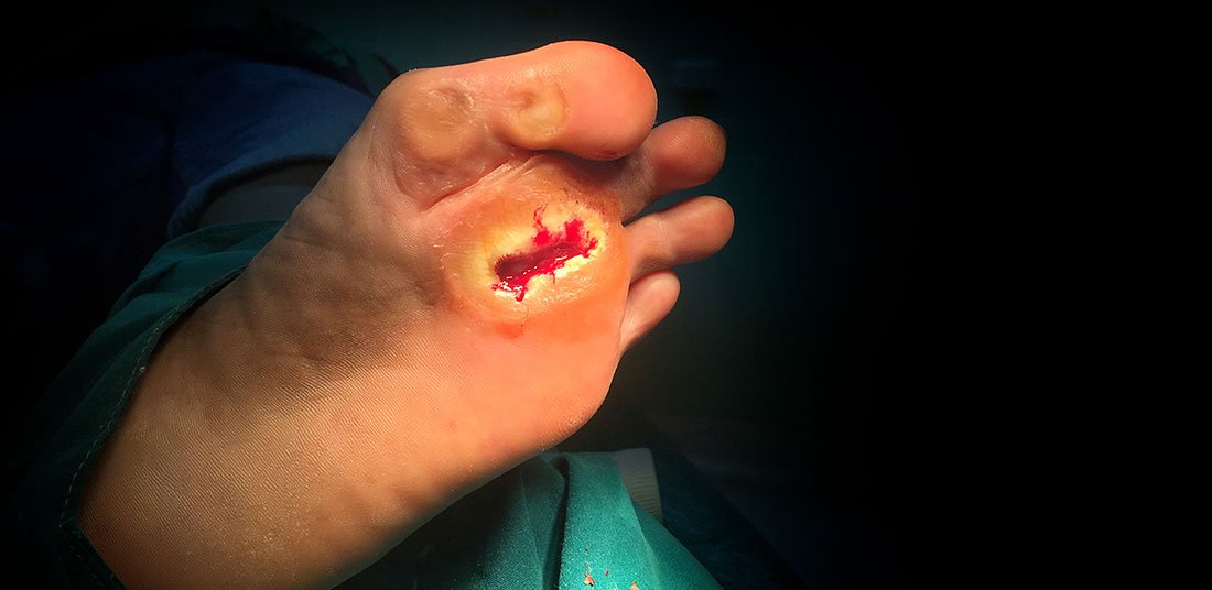 Foot Ulcer