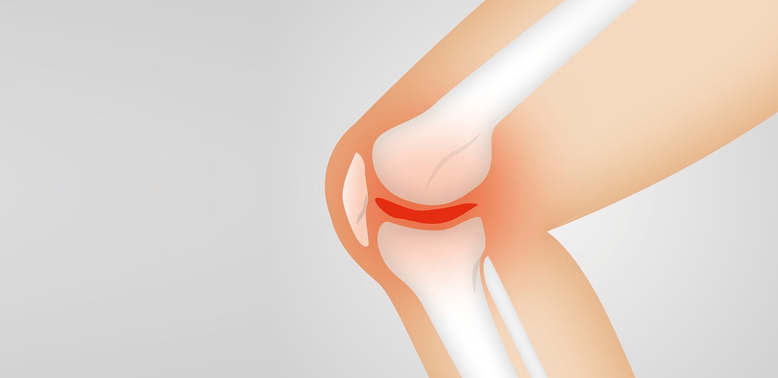 Torn Meniscus