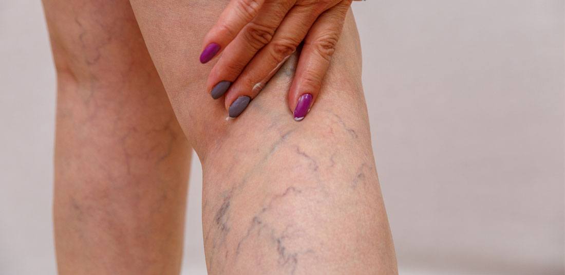 Varicose Veins