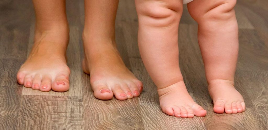 In-toeing in a child