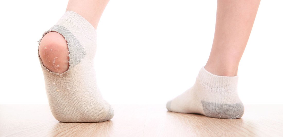 Why Did My Heel Pain Come Back?