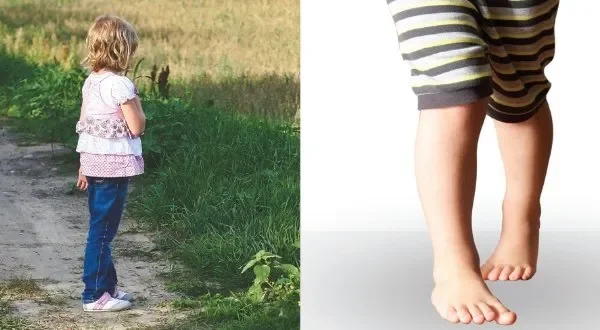 young child with knock knees