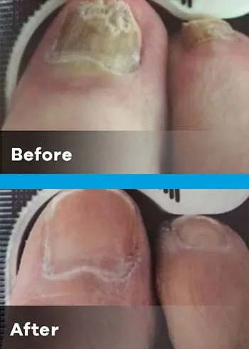 onychomycosis before and after