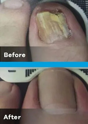 onychomycosis thumb with index before and after