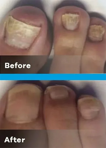 onychomycosis triple toe