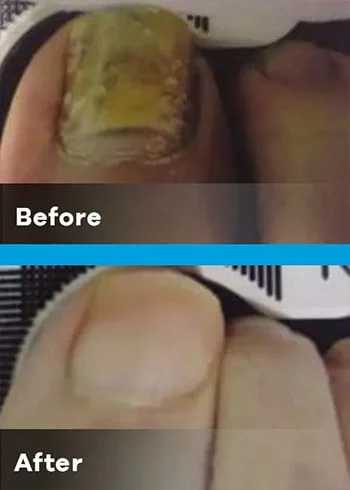 onychomycosis yellow thumb and index before and after