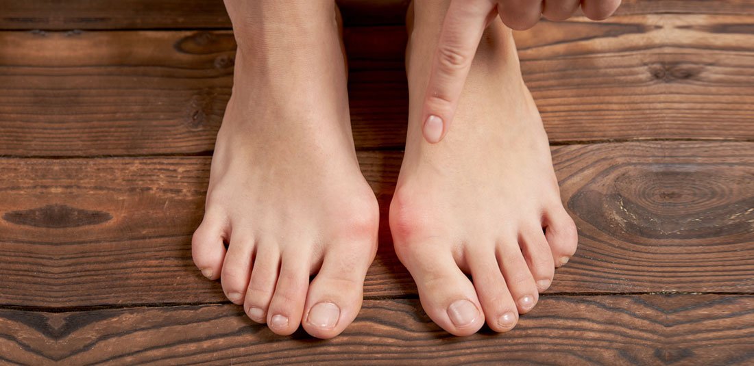 Treating Bunions Toe Pain At 40 Years Old